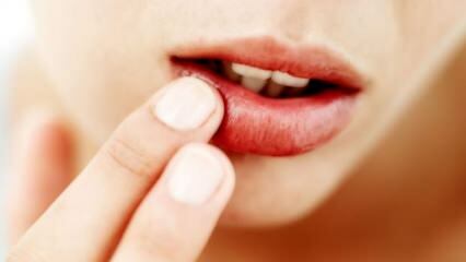 ¿Qué es bueno para el agrietamiento de los labios?
