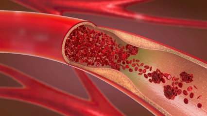 ¿Qué es la anemia (anemia)? ¡La debilidad constante indica anemia! Alimentos que son buenos para la anemia ...