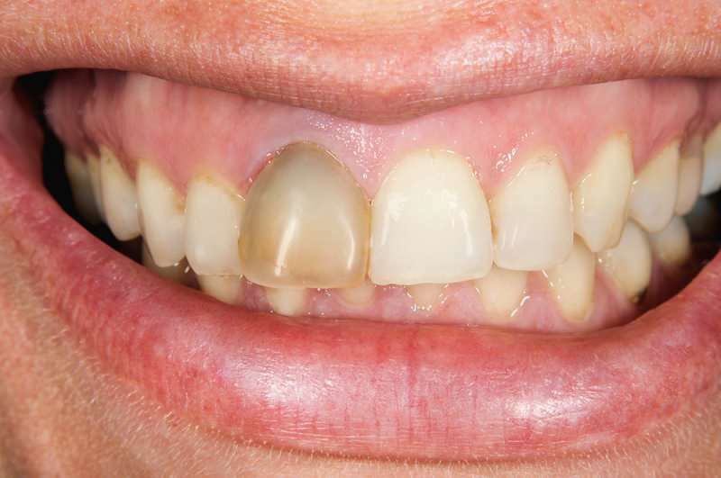 el oscurecimiento de los dientes a veces puede concentrarse en un diente