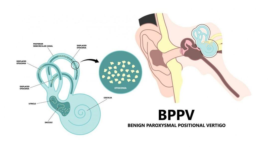 ¿Por qué la cabeza da vueltas al acostarse? ¿Qué es bueno para el vértigo posicional paroxístico benigno? Cómo deshacerse del VPPB