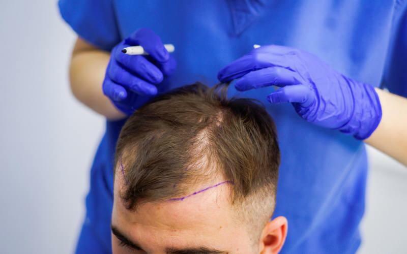 ¿Está permitido someterse a un trasplante de cabello en el tratamiento de la caída del cabello? ¿Qué es el cabello protésico? ¿El cabello protésico previene el ghusl?