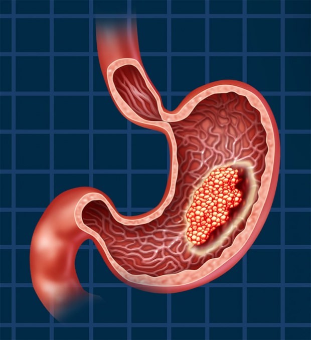 ¿Cómo se produce el cáncer de estómago? ¿Cuáles son los síntomas del cáncer de estómago? ¿Existe un tratamiento para el cáncer de estómago?