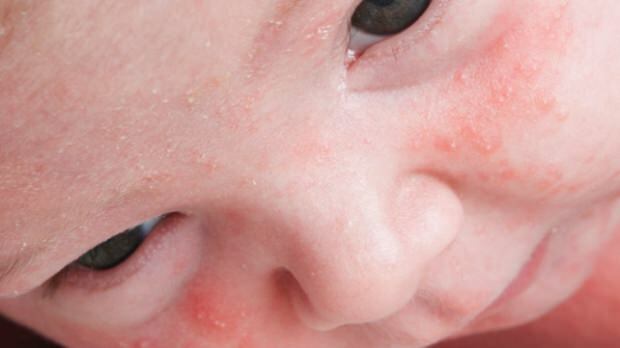 ¿Cómo pasan el acné en los bebés?