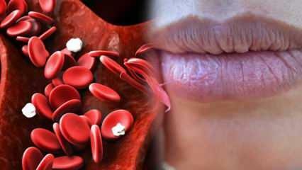 ¿Qué es la anemia? ¡La debilidad constante es un signo de anemia! Alimentos que son buenos para la anemia ...