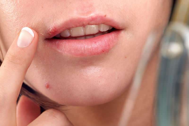 el herpes generalmente sale del borde del labio.