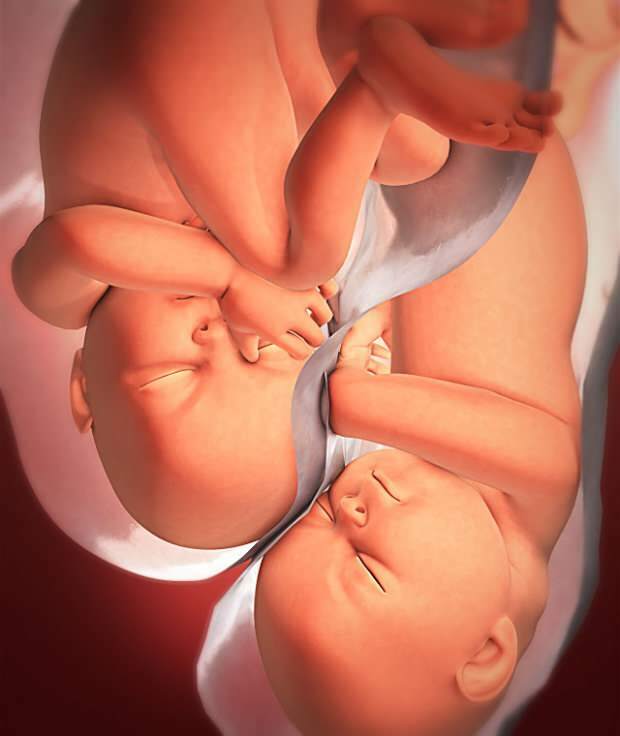¿Cuáles son los síntomas del embarazo gemelar?