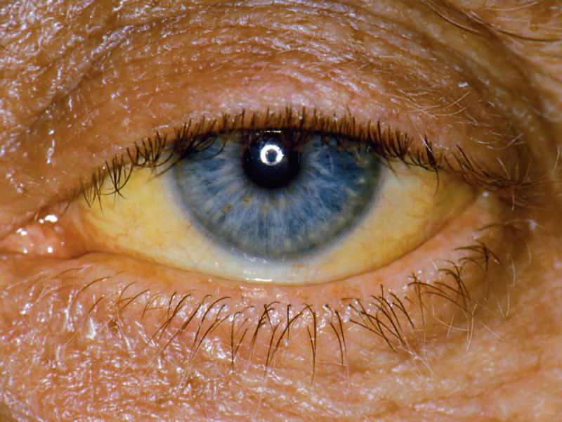 la altura a nivel de bilirrubina provoca un color amarillo en los ojos y la piel