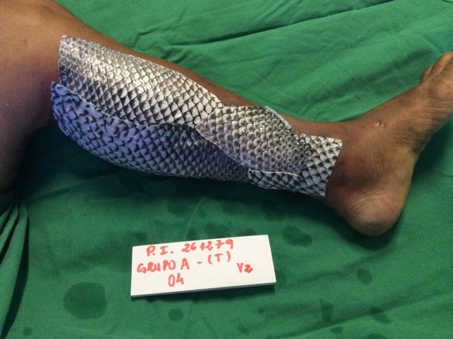 La piel de pescado ha pasado al historial médico en el tratamiento de quemaduras.