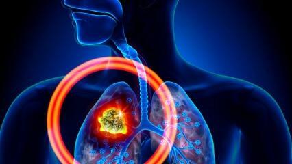 cuáles son los síntomas del cáncer de pulmón? ¿Existe un tratamiento para el cáncer de pulmón?