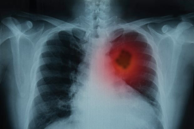 ¿Cuáles son los síntomas del cáncer de pulmón? ¿Existe un tratamiento para el cáncer de pulmón? Para prevenir el cáncer de pulmón ...