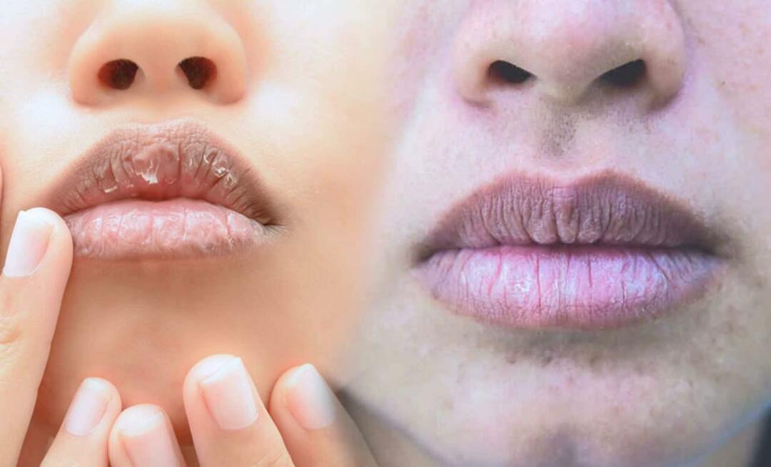 ¿Qué causa los labios oscuros? ¿Cómo se trata el oscurecimiento de los labios o los moretones?