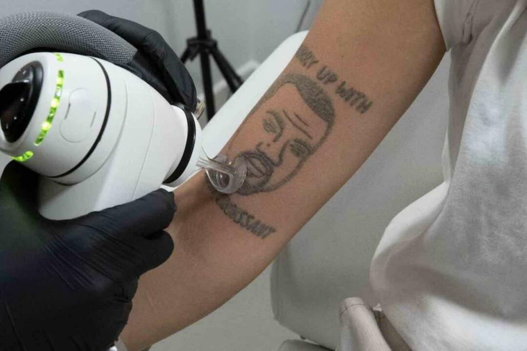 Tatuaje de Kanye West será eliminado gratis en Londres 