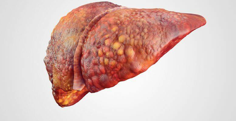 etapas del hígado graso