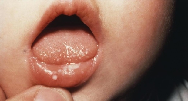 ¿Cómo son las llagas en la boca en los bebés?