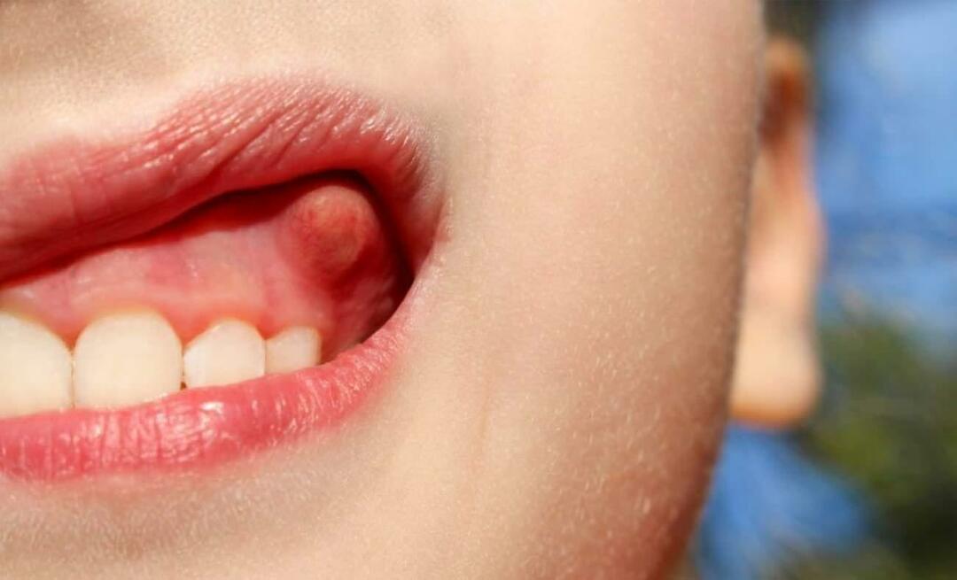 ¿Por qué el absceso dental y cuáles son los síntomas? Absceso dental, ¿cómo se trata?