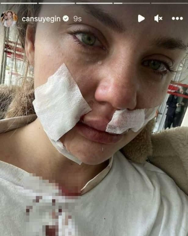 Cansu Yeğin fue atacada por un perro