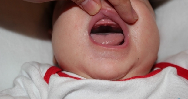 ¿Qué es la caída del paladar en los bebés, por qué? Síntomas y tratamiento ...