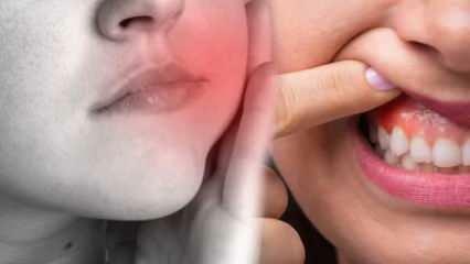 ¿Qué causa un absceso dental? ¿Cuáles son los síntomas y en cuántos días? Soluciones naturales para los abscesos dentales...