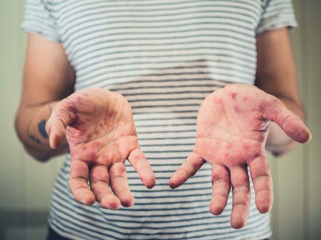 ¿Cuáles son los síntomas de la enfermedad de manos, pies y boca?