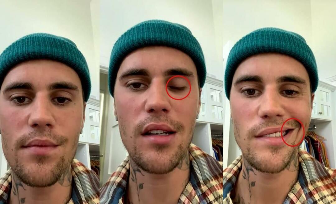 ¡Justin Bieber tuvo una parálisis facial! La famosa estrella no puede volver a hacer una gira mundial