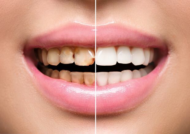 Como resultado de una nutrición poco saludable, se producen decoloración y pérdida de dientes.