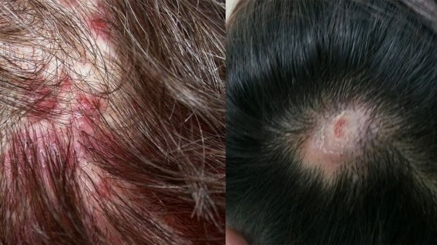 ¿Por qué aparece el acné en el cuero cabelludo?