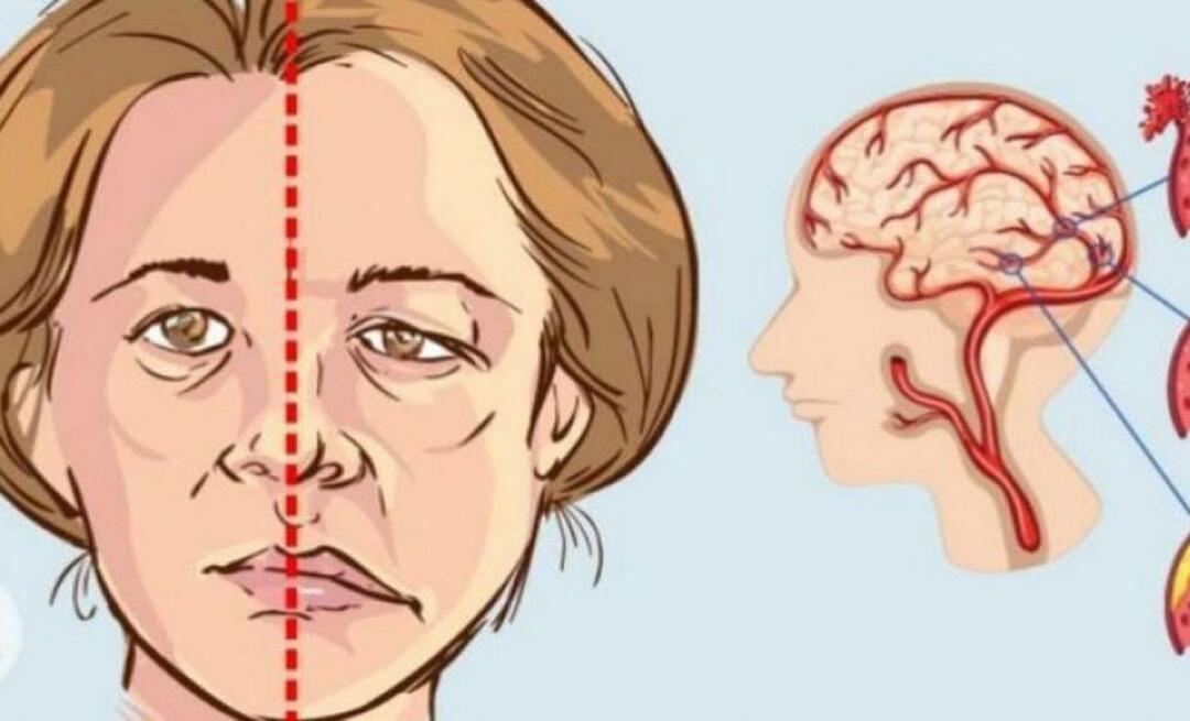 ¿Qué es un derrame cerebral? ¿Cuáles son los síntomas del accidente cerebrovascular? ¿Cómo prevenir un ictus?