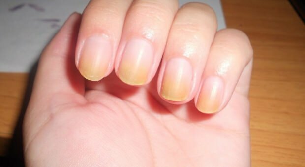 Causas del amarillamiento de las uñas.
