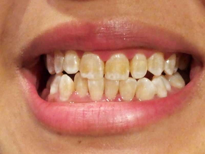 imagen del diente de una persona cuyos dientes comienzan a oscurecerse