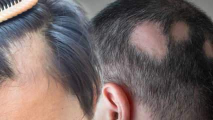 ¿Qué es la tiña (Alopecia areata)? ¿Cuáles son los síntomas de la tiña? Soluciones efectivas para la tiña