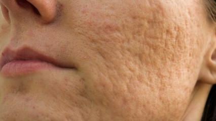 ¿Cómo van las cicatrices del acné en la cara? Recetas de mascarillas que eliminan las cicatrices del acné