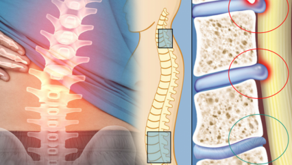 ¿Qué es el estrechamiento de la médula espinal? ¿Cuáles son los síntomas del estrechamiento de la médula espinal? ¿Existe una cura para el estrechamiento de la médula espinal?