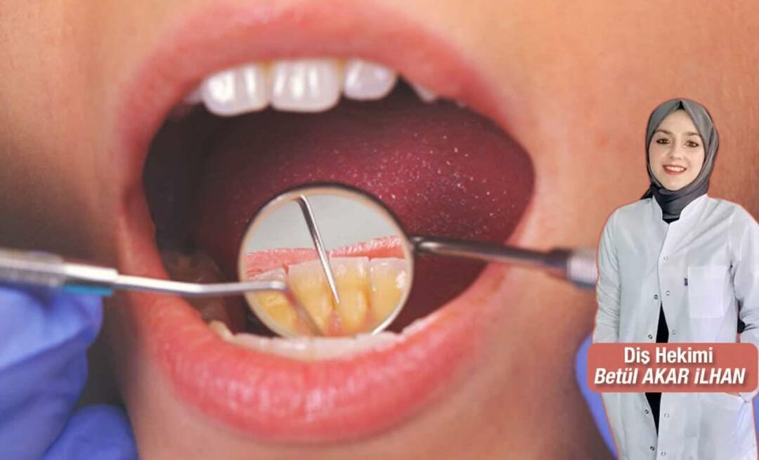 ¿Qué se debe hacer para evitar el sarro? ¿Cuáles son los beneficios del raspado dental?