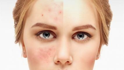 Las cremas para combatir el acné más efectivas y mejores en la farmacia 2021