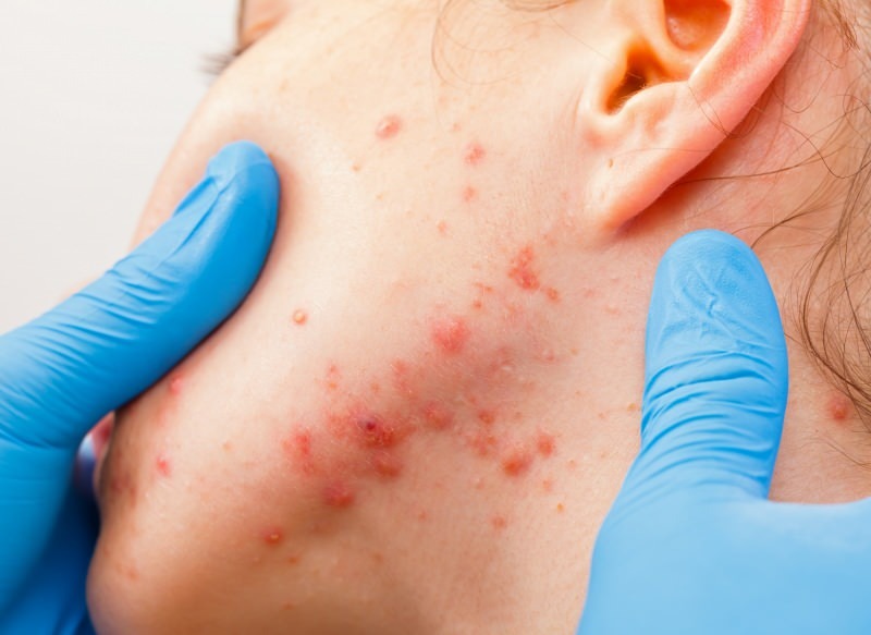 el virus causa ampollas en la superficie de la piel