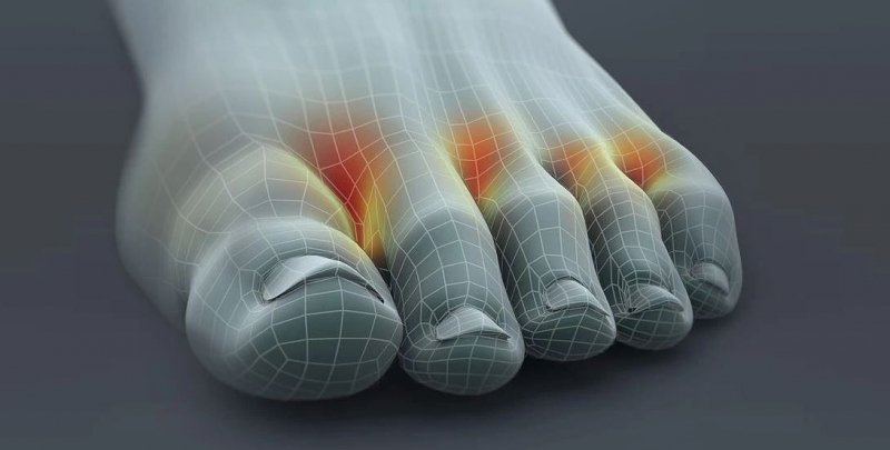 el hongo de pie más común es entre los dedos de los pies