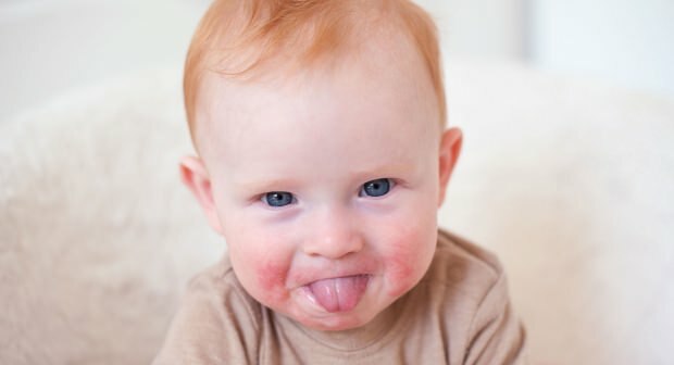 ¡Atención en bebés con mejillas rojas! Síndrome de mejilla abofeteada y sus síntomas.
