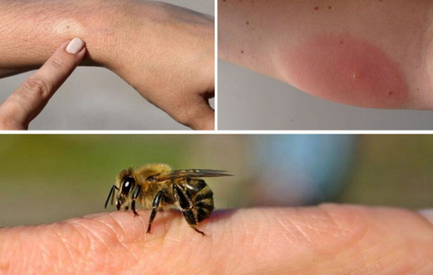 síntomas de alergia a las abejas