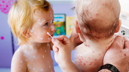 ¿Cómo entender la varicela en la infancia y la infancia? Síntomas y tratamiento de la varicela