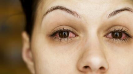 ¿Qué es la conjuntivitis (gripe ocular) y cuáles son los síntomas? ¿Cómo se transmite la conjuntivitis?